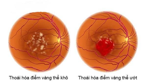 Ánh Sáng Xanh là gì? Tác hại của nó tới mắt như thế nào? thai hoa diem vang